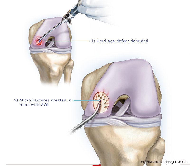 microfracture.jpg