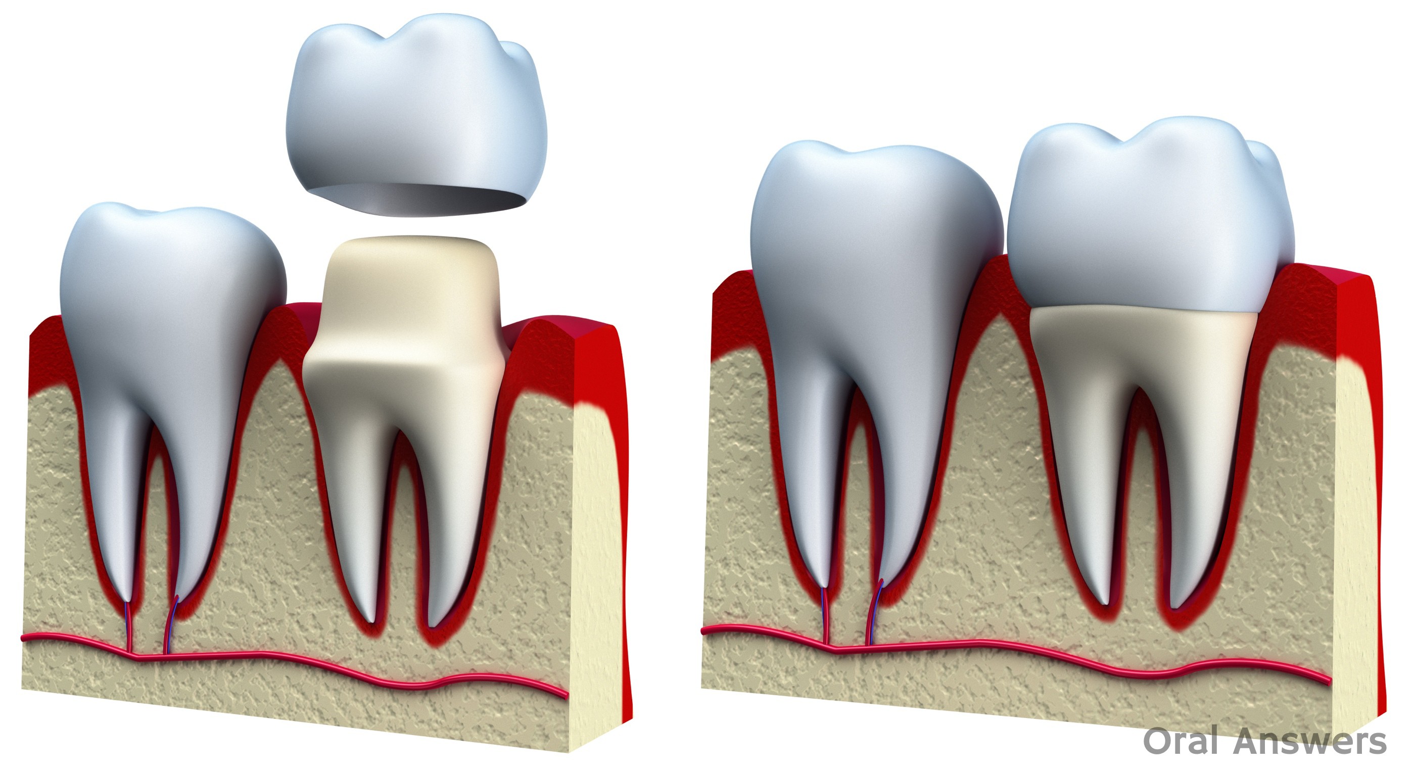 dental_crown_getting_seated_and_cemented.jpg